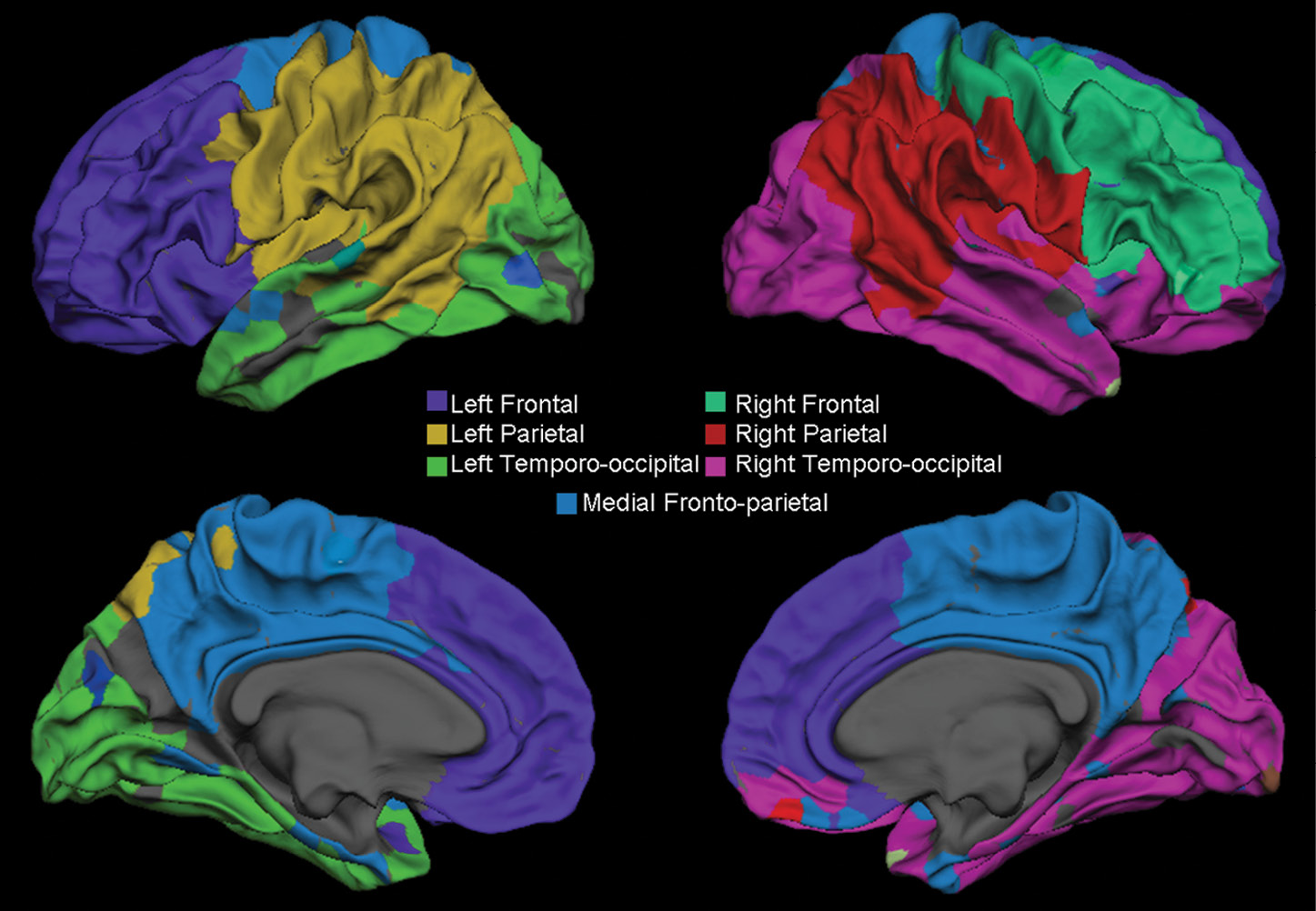 Surface representation shows the gray–white matter junction Surface representation shows the gray–white matter junction